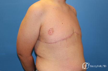 Denver FTM Female to male top surgery 5255 - After Image 2