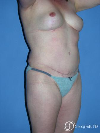Denver Mommy makeover, breast reduction, abdominoplasty, liposuction 5355 - After Image 2