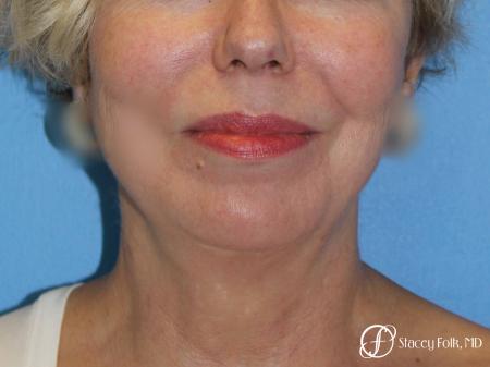 Denver Facial Rejuvenation Facelift, Fat Transfer, and Laser Resurfacing 8513 - After Image 3