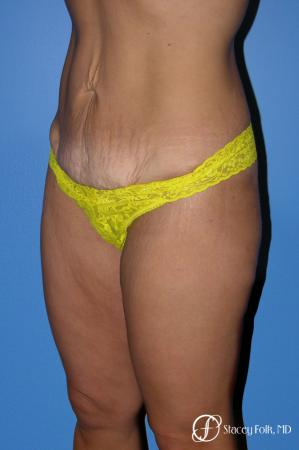 Denver Tummy Tuck Abdominoplasty 5368 - Before Image 2