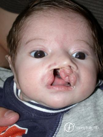 Denver Cleft Lip and Palate Repair 57 - Before Image 1