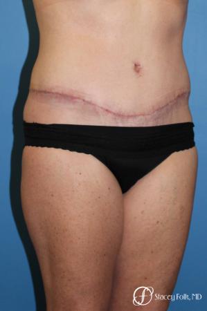 Denver Tummy Tuck 4817 - After Image 2