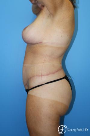 Denver Mommy Makeover Belt lipectomy, liposuction, mastopexy 5938 - After Image 3