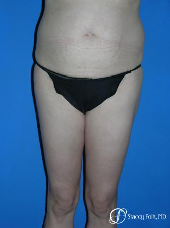 Denver Liposuction 3527 - Before Image 1