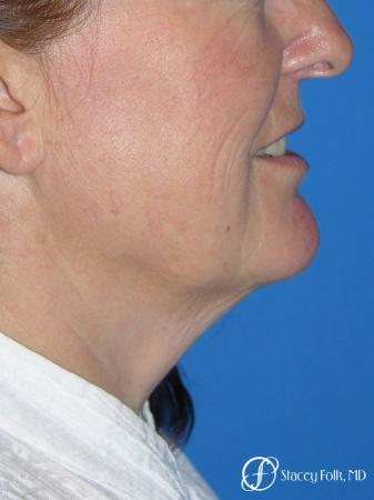 Denver Facial Rejuvenation Face lift, Fat Injections, Laser Resurfacing 7133 - Before Image 1