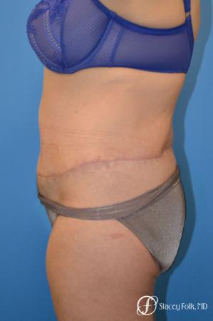 Denver Body Lift 4796 - After Image 3