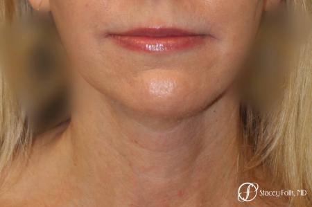 Denver Facial Rejuvenation Face Lift and Fat Injections 7126 - After Image 3