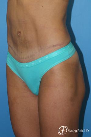 Denver Tummy Tuck - Abdominoplasty 8299 - After Image 2