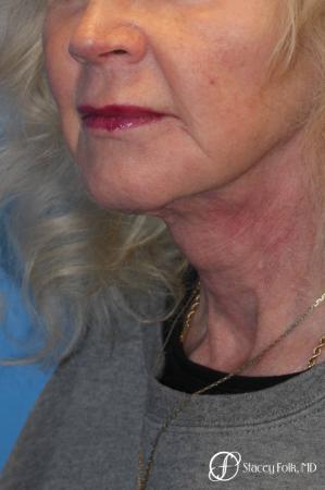 Denver Facial Rejuvenation Face lift, Fat Injections, and Laser Resurfacing 7131 - After Image 2
