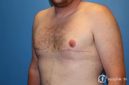 Denver FTM Female to Male Top Surgery 7109 - After Image 2