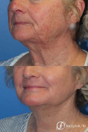 Denver Laser Skin Resurfacing Face 10665 - After Image 1
