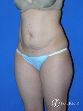 Denver Tummy Tuck 35 - Before Image 2