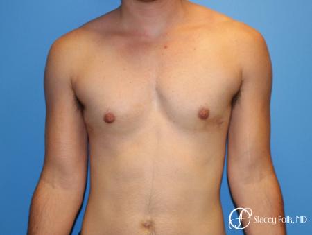 Denver FTM female to male top surgery using gynecomastia technique 5128 - 1 After Image 1