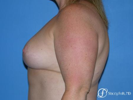 Denver Breast Reduction 4799 - After Image 3