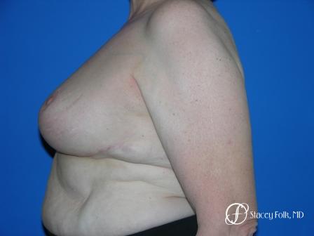 Denver Breast Reduction 37 - After Image 3