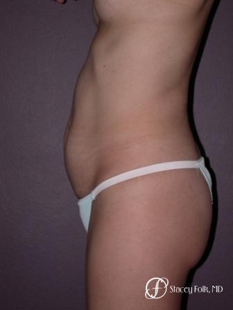 Denver Tummy Tuck 22 - Before and After Image 2