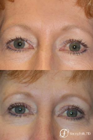 Denver Blepharoplasty 10316 - Before Image 1