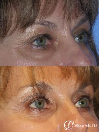 Denver Brow lift, Upper and Lower Lid Blepharoplasty 7162 - After Image 1