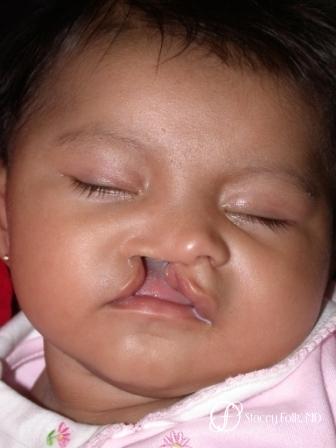 Denver Cleft Lip and Palate Repair 966 - Before 1