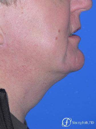 Denver Facial Rejuvenation Face lift, and Fat injections 7157 - After Image 2