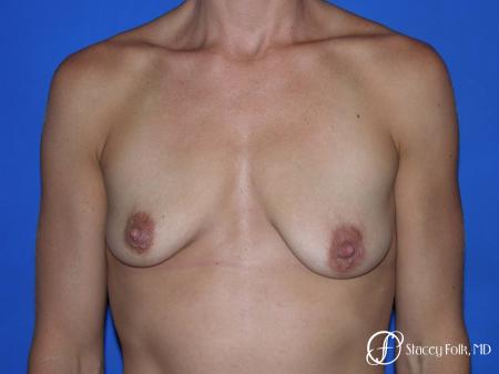 Denver Breast augmentation and breast lift (Mastopexy) 10091 - Before Image 1