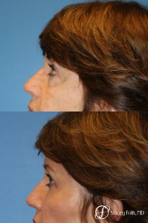 Denver Lower Lid Blepharoplasty 8640 - After Image 1