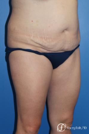 Denver Tummy Tuck (Abdominoplasty) and liposuction 10371 - Before Image 2