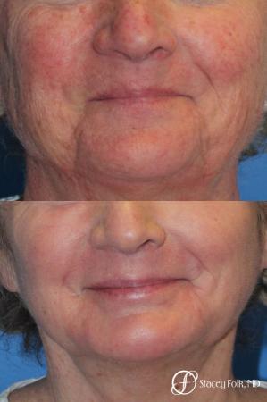 Denver Laser Skin Resurfacing Face 10665 - Before Image 1