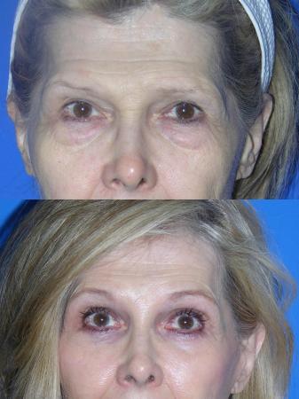 Denver Brow lift, Upper Blepharoplasty 7160 - Before Image 1