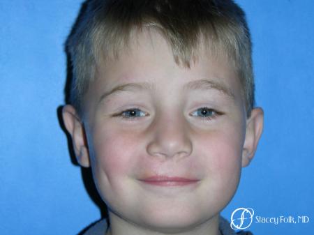 Denver Cleft Lip and Palate Repair 3304 - After Image 1