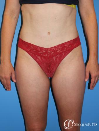 Denver Tummy Tuck - Abdominoplasty 8266 - After Image 1