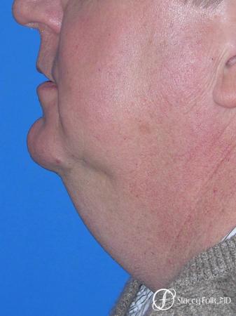 Denver Facial Rejuvenation Face lift, and Fat injections 7157 - Before Image 1