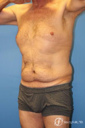 Denver Body Lift - Belt Lipectomy 8570 - Before and After Image 3