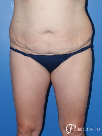 Denver Tummy Tuck (Abdominoplasty) and liposuction 10371 - Before Image 1