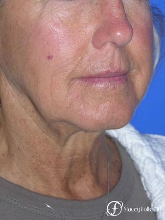 Denver Facial Rejuvenation Face Lift and Laser Resurfacing 7119 - Before Image 2