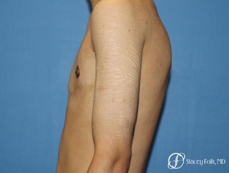 Denver FTM Female to male top surgery 5105 - After Image 3