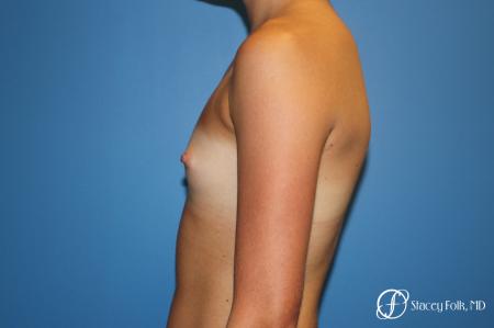Denver Breast Augmentation with Sientra Breast Implants 9094 - Before and After Image 3