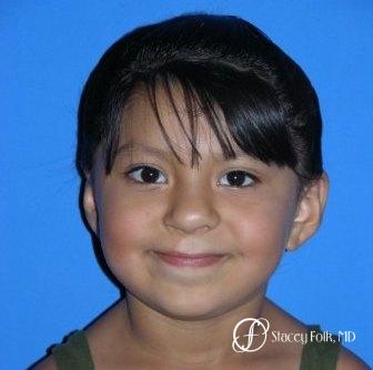 Denver Cleft Lip and Palate Repair 966 - After 1