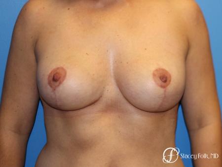 Denver Breast Lift - Mastopexy 7988 - After Image 1