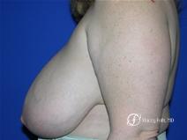 Denver Breast Reduction 16 - Before and After Image 3