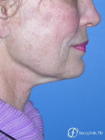 Denver Facial Rejuvenation Face Lift, Fat Injections, Laser Resurfacing 7116 - Before Image 1