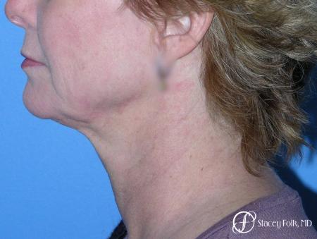 Denver Facial Rejuvenation Face Lift 7121 - Before Image 1