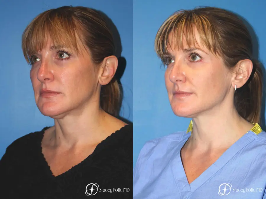 Denver Thermitight 5259 - Before and After 4