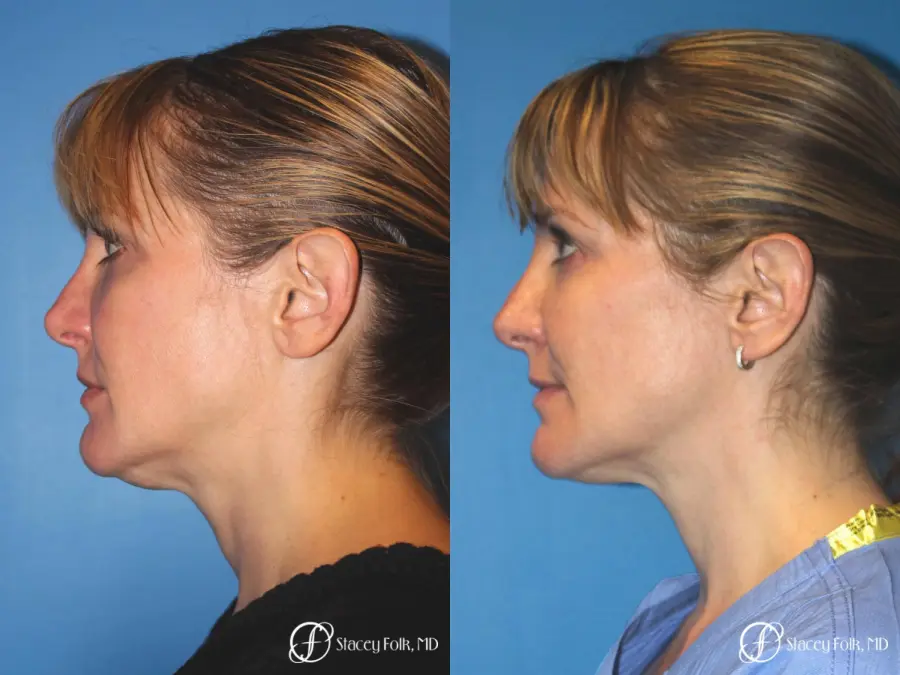 Denver Thermitight 5259 - Before and After 5
