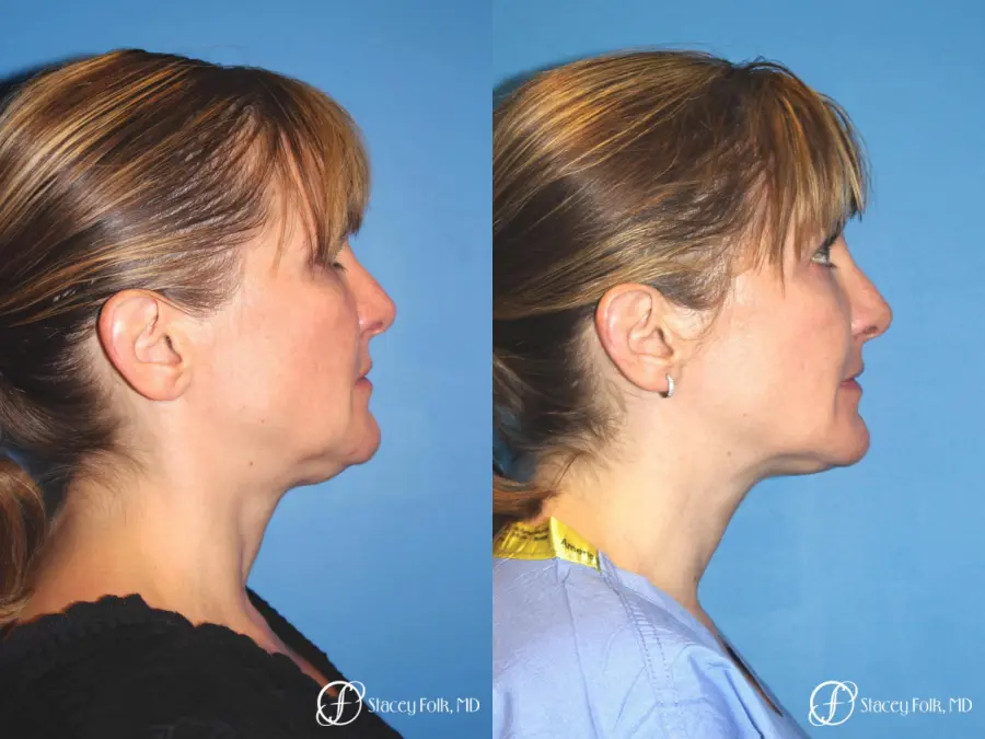 Denver Thermitight 5259 - Before and After 3
