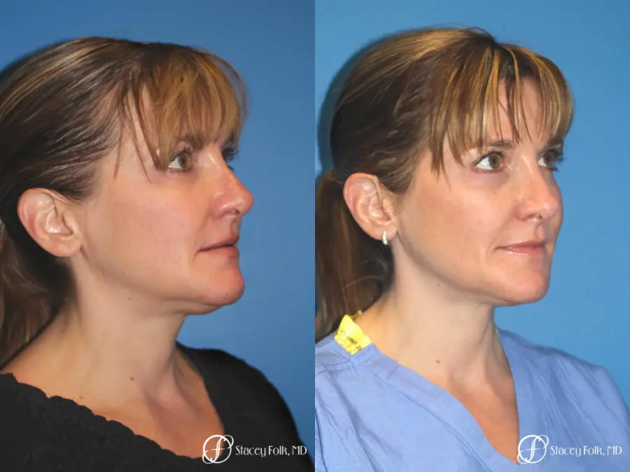 Denver Thermitight 5259 - Before and After 2