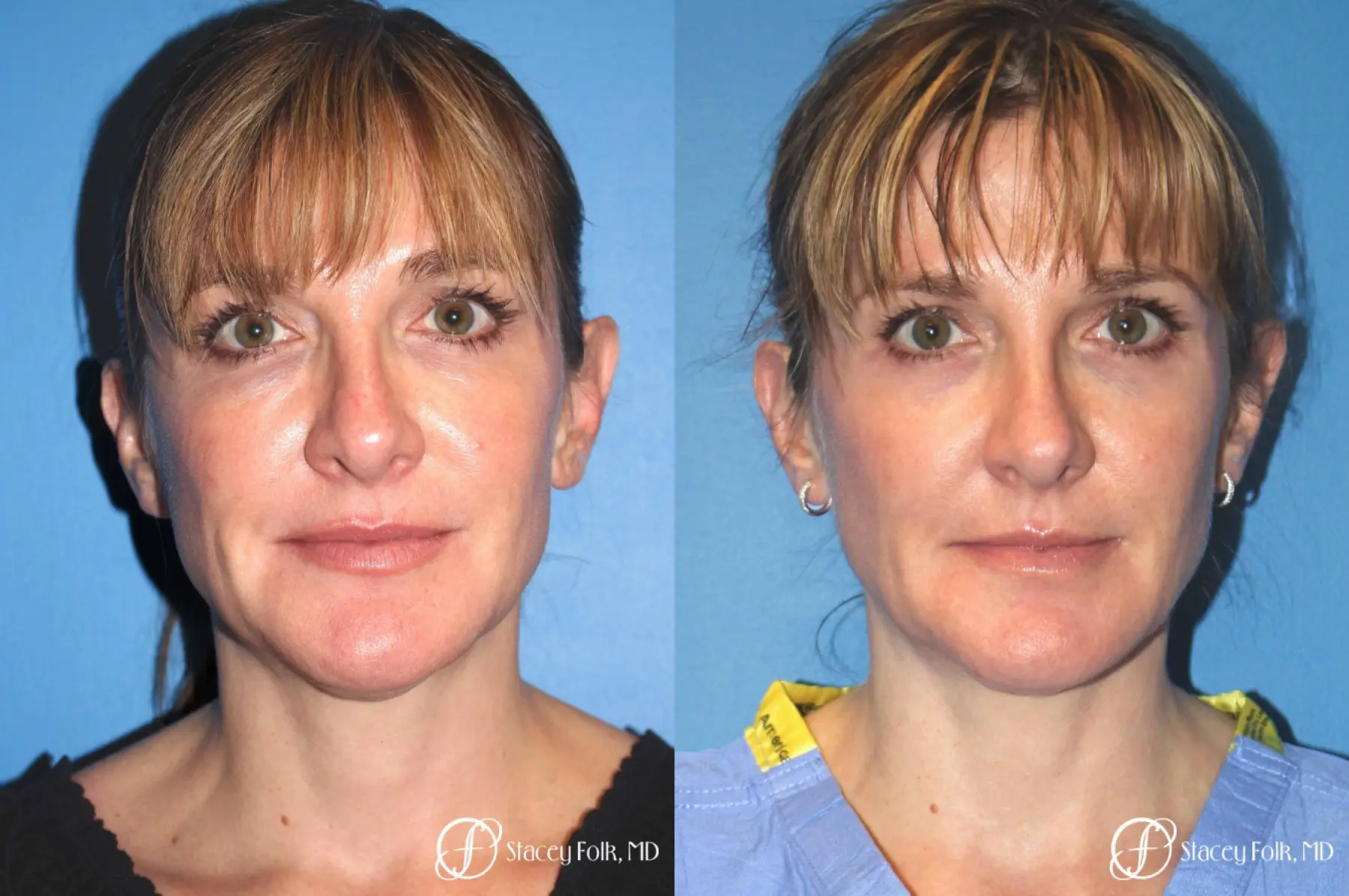 Denver ThermiTight Neck and Face 9391 - Before and After