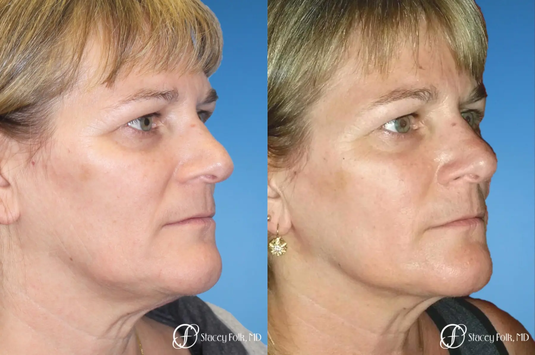 Denver ThermiTight Neck and Face 9392 - Before and After