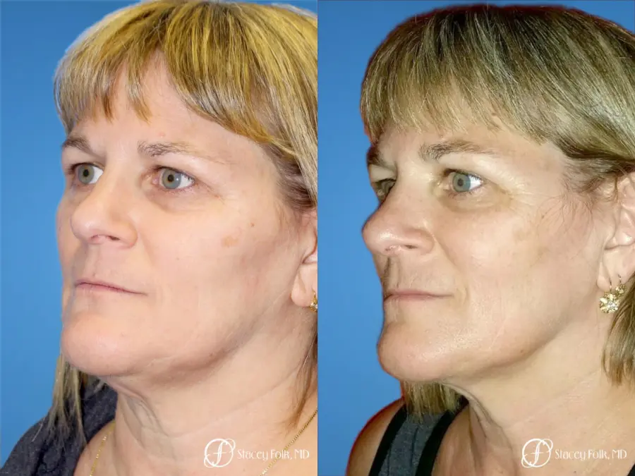 Denver ThermiTight Neck and Face 9392 - Before and After 2