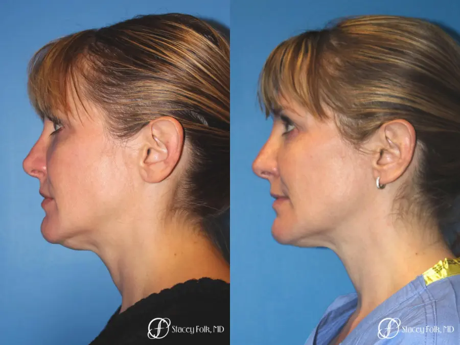 Denver ThermiTight Neck and Face 9391 - Before and After 5